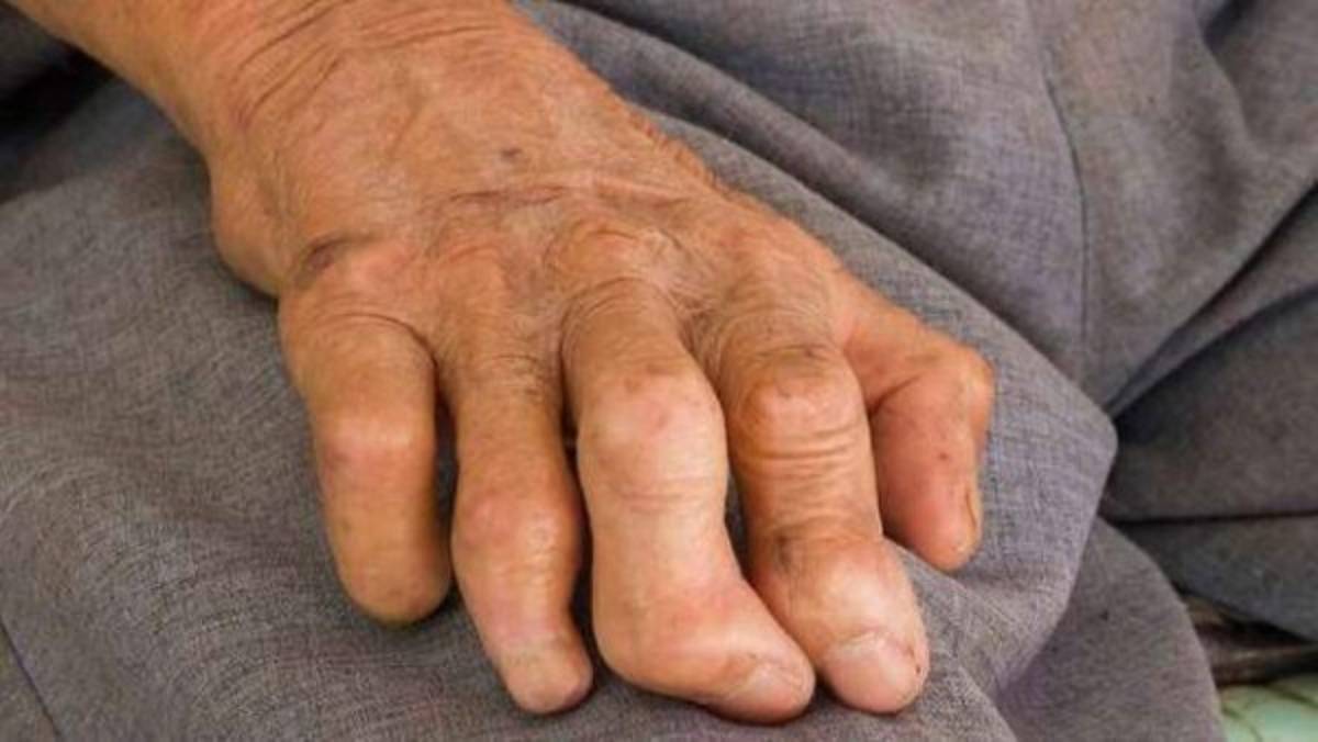 Alerta en México tras reportarse 89 casos de lepra, algo que pone en vigilancia al sector salud