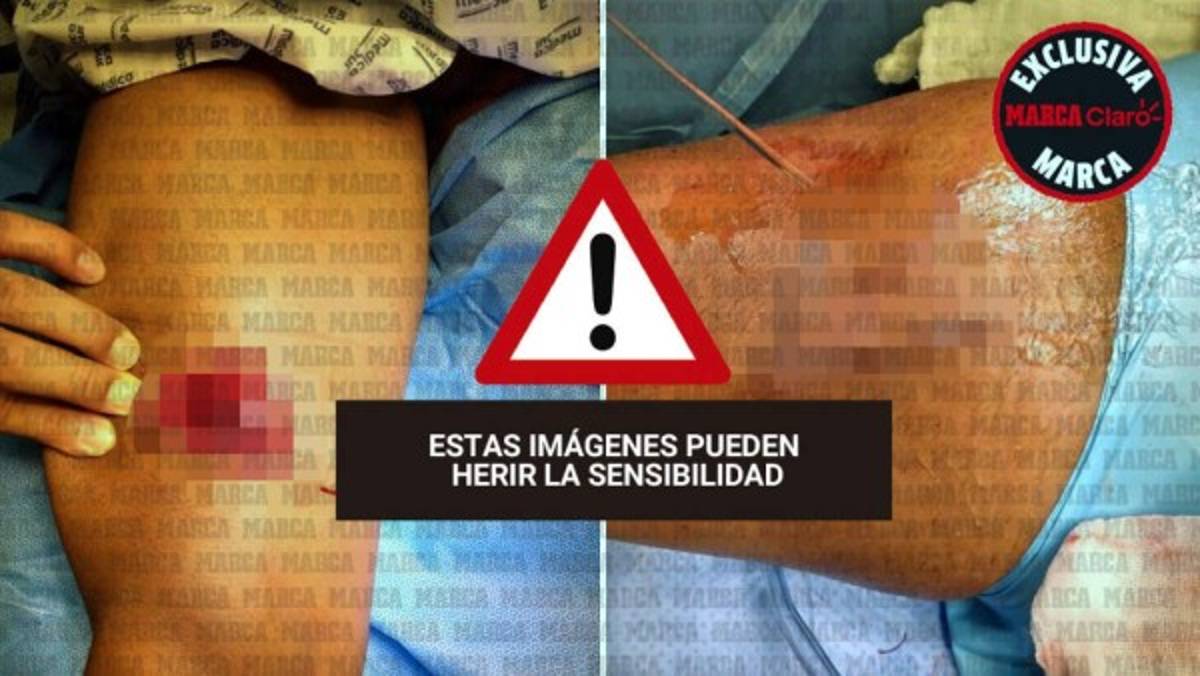 FOTOS: Reconstruyen el muslo de Gio Dos Santos tras lesión en el América-Chivas