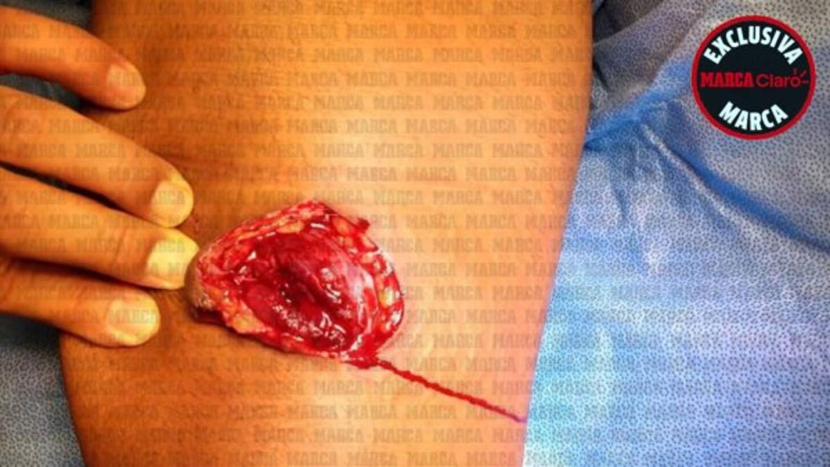 FOTOS: Reconstruyen el muslo de Gio Dos Santos tras lesión en el América-Chivas