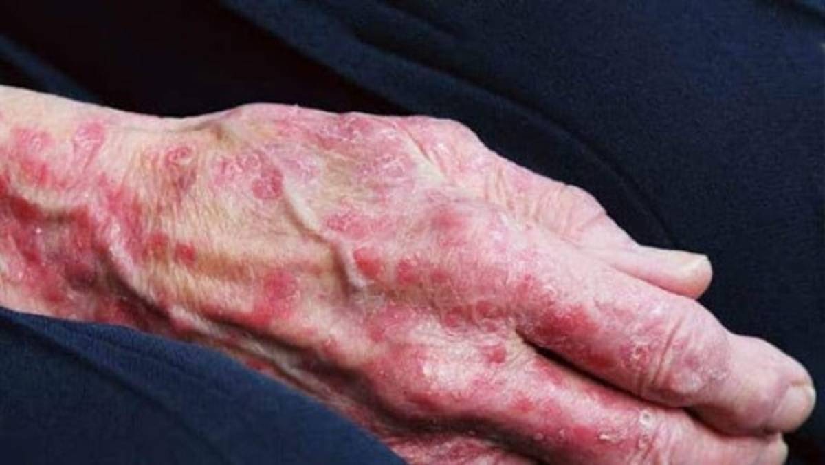 Alerta en México tras reportarse 89 casos de lepra, algo que pone en vigilancia al sector salud