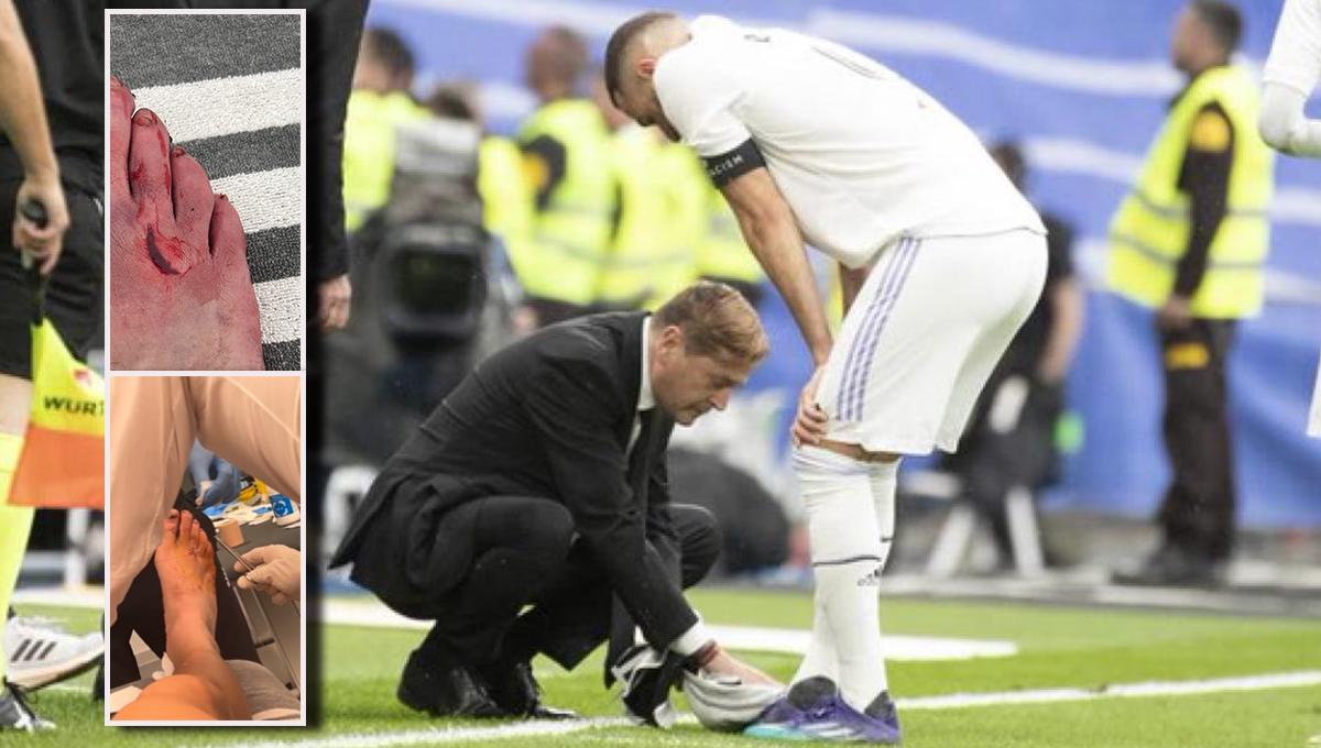 Así le quedó el pie a Benzema: jugó todo el partido con un terrible corte y termina con cinco puntos de sutura