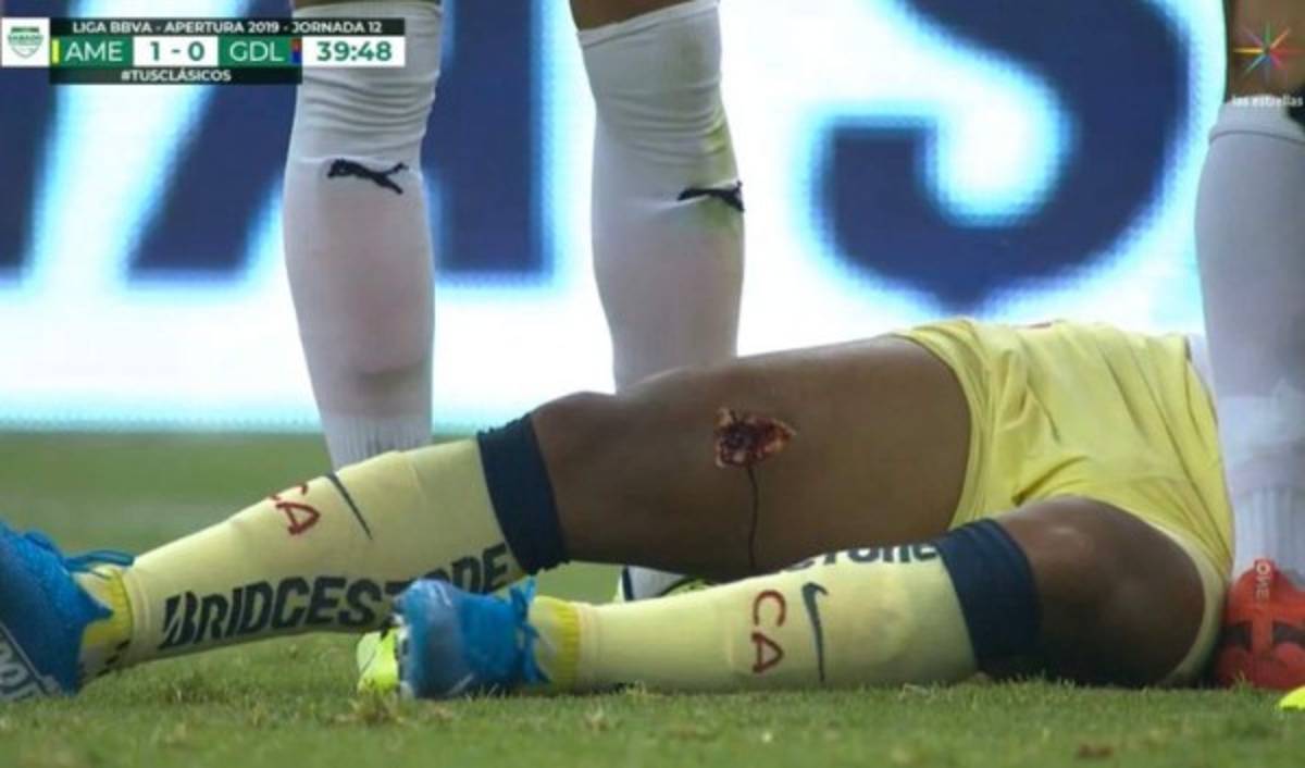 FOTOS: Reconstruyen el muslo de Gio Dos Santos tras lesión en el América-Chivas