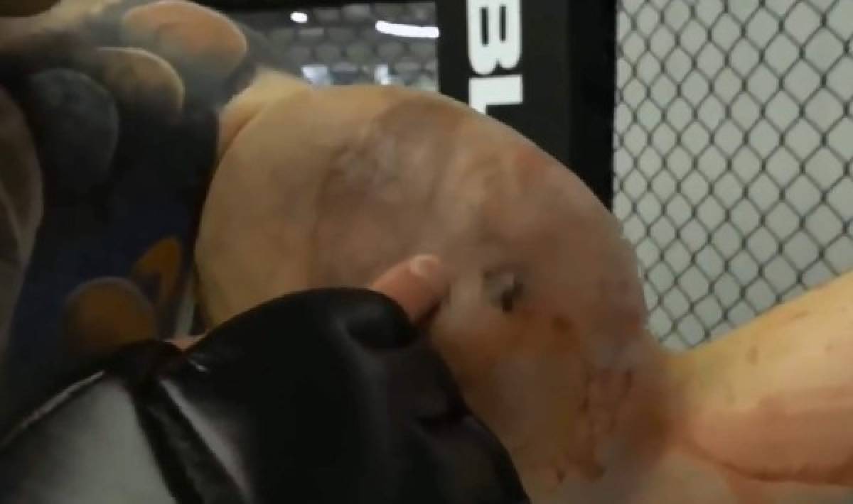 La fea lesión del Popeye ruso: le 'explotan' un brazo en plena pelea y anuncia que es el final