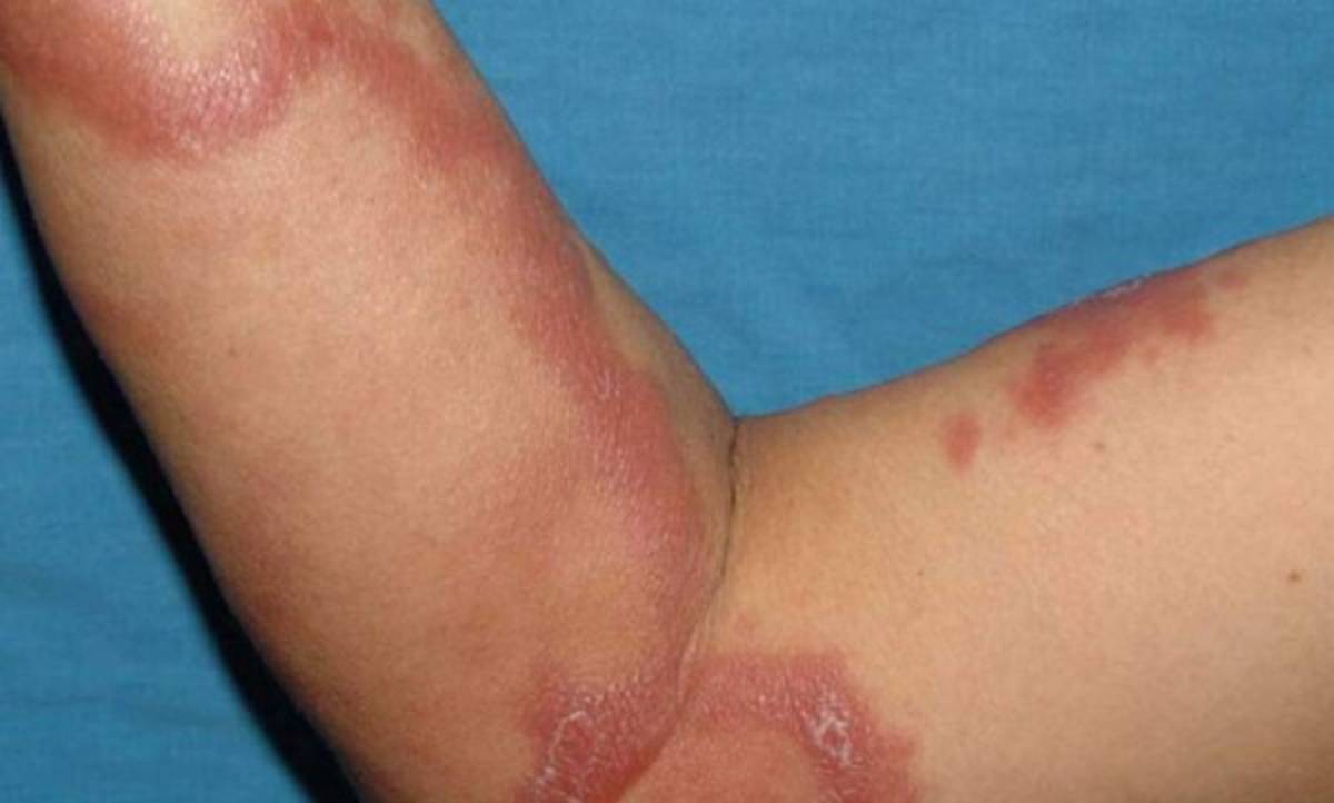 Alerta en México tras reportarse 89 casos de lepra, algo que pone en vigilancia al sector salud