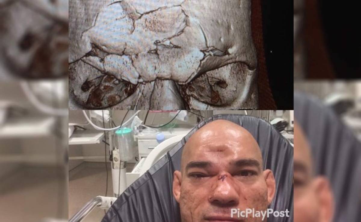 VIDEO: Rompen de un rodillazo el cráneo a Evangelista Santos