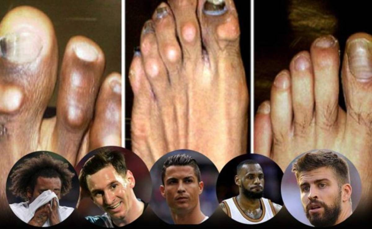 ¡HORRIBLES! Así son los pies más feos de los deportistas famosos