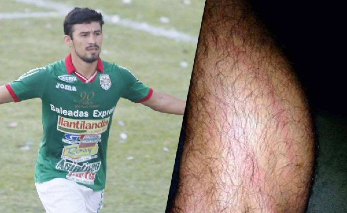 Rambo Rodríguez muestra cómo le quedó la pierna tras el 'cariño' de Carlos Will Mejía