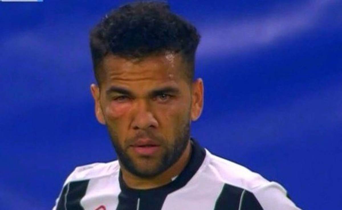 Terrible golpe dejó con el ojo hinchado a Dani Alves