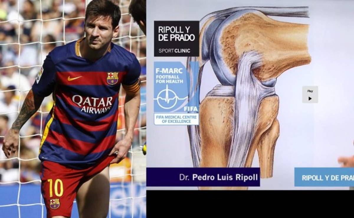VIDEO: Especialista explica en qué consiste la lesión de Messi