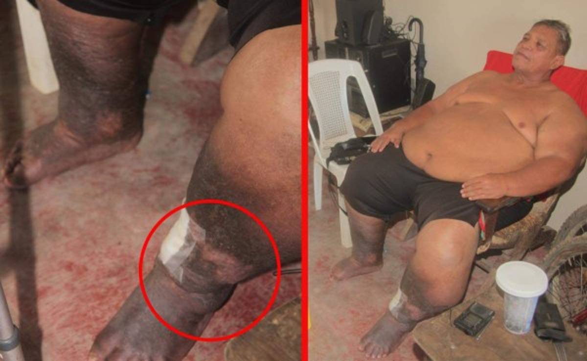 'Paciencia' Núñez clama ayuda para evitar amputación de sus piernas