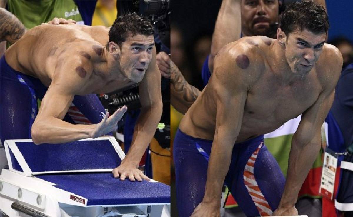 ¿Qué son las marcas redondas que tiene Michael Phelps en su espalda?