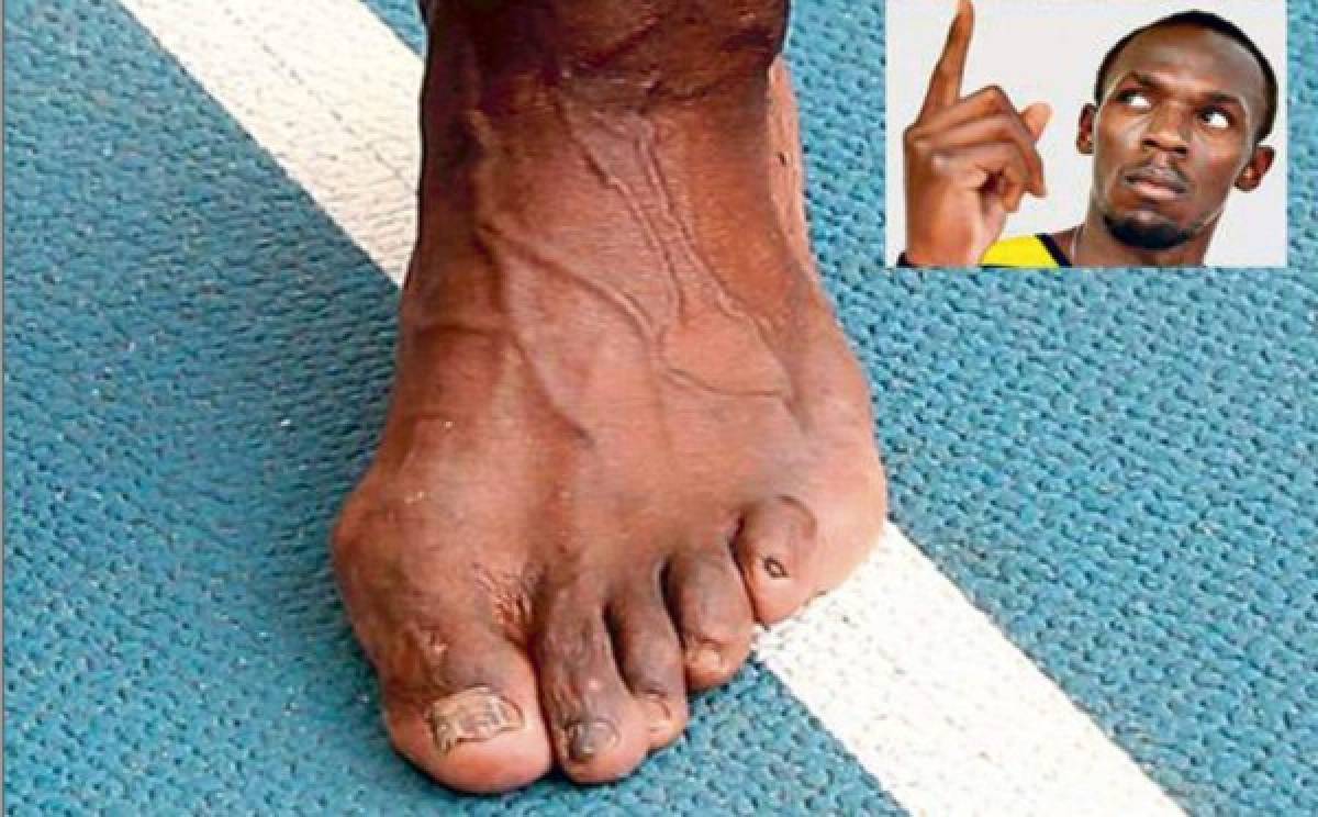 FOTOS: Así son los pies más feos de algunos deportistas reconocidos