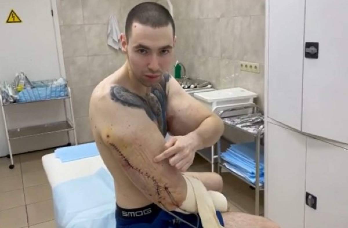 La fea lesión del Popeye ruso: le 'explotan' un brazo en plena pelea y anuncia que es el final