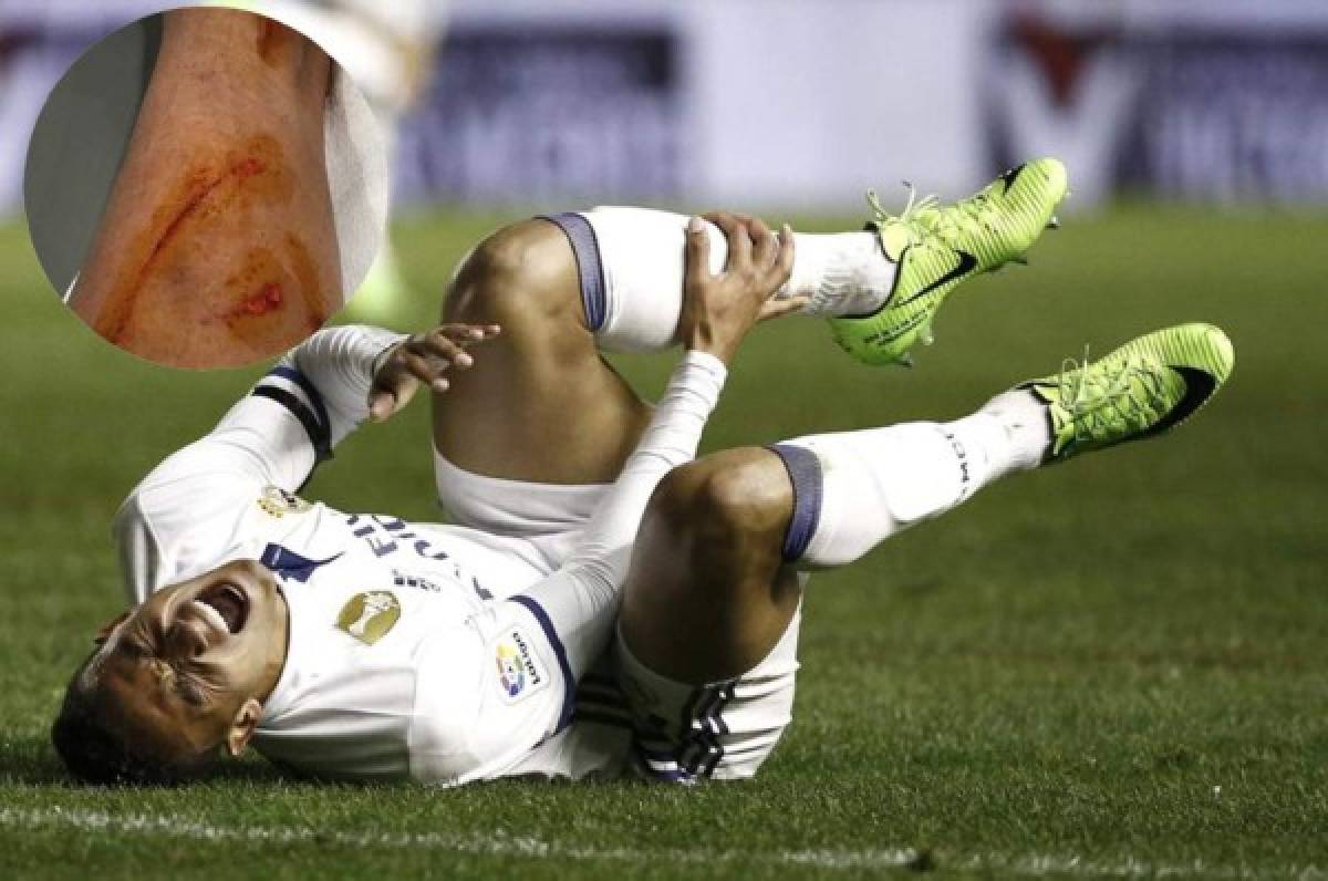 Dan a conocer la verdadera lesión de Danilo, jugador del Real Madrid