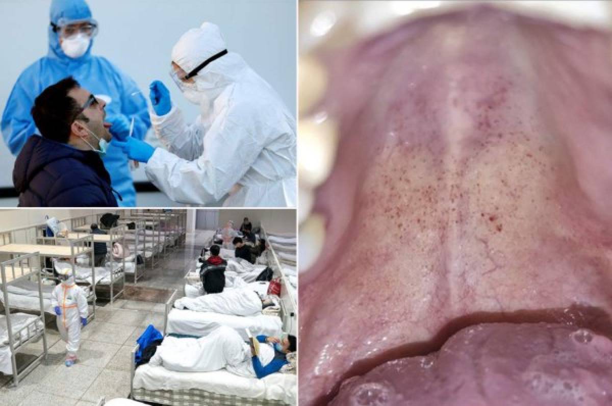 COVID-19: Médicos españoles descubren nuevo y extraño síntoma en pacientes contagiados