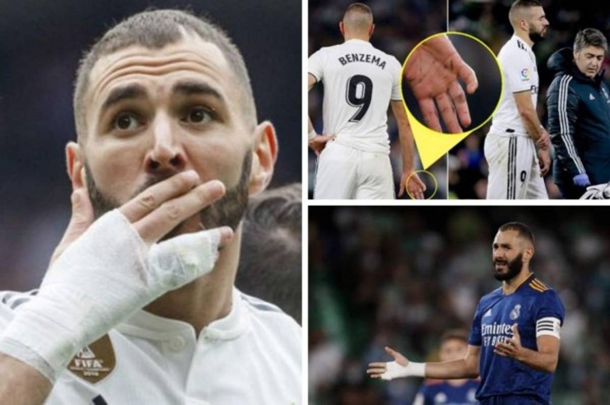 Benzema y la misteriosa lesión en su mano: Así tiene el dedo y aclara por qué no se opera