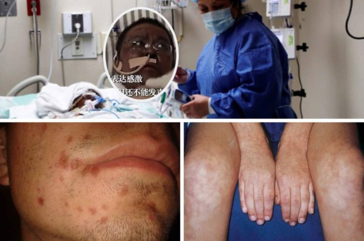 Nuevos síntomas del coronavirus: Las cinco manifestaciones que se producen en la piel  
