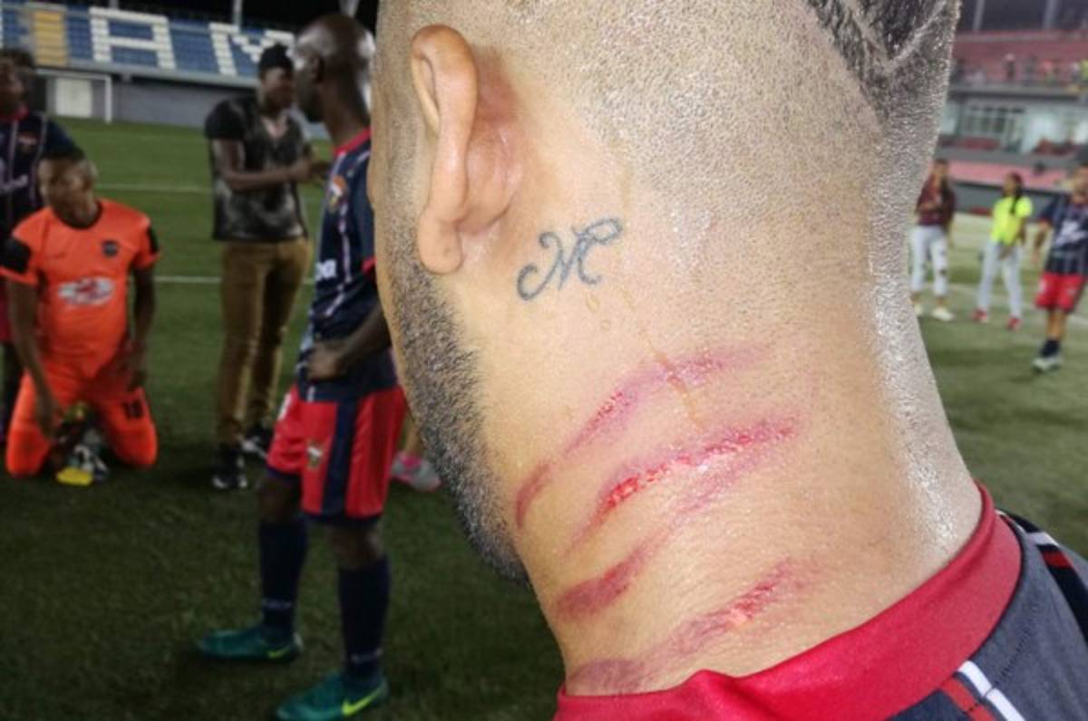 Pelea entre dos jugadores en Panamá deja a uno con serias heridas en el cuello
