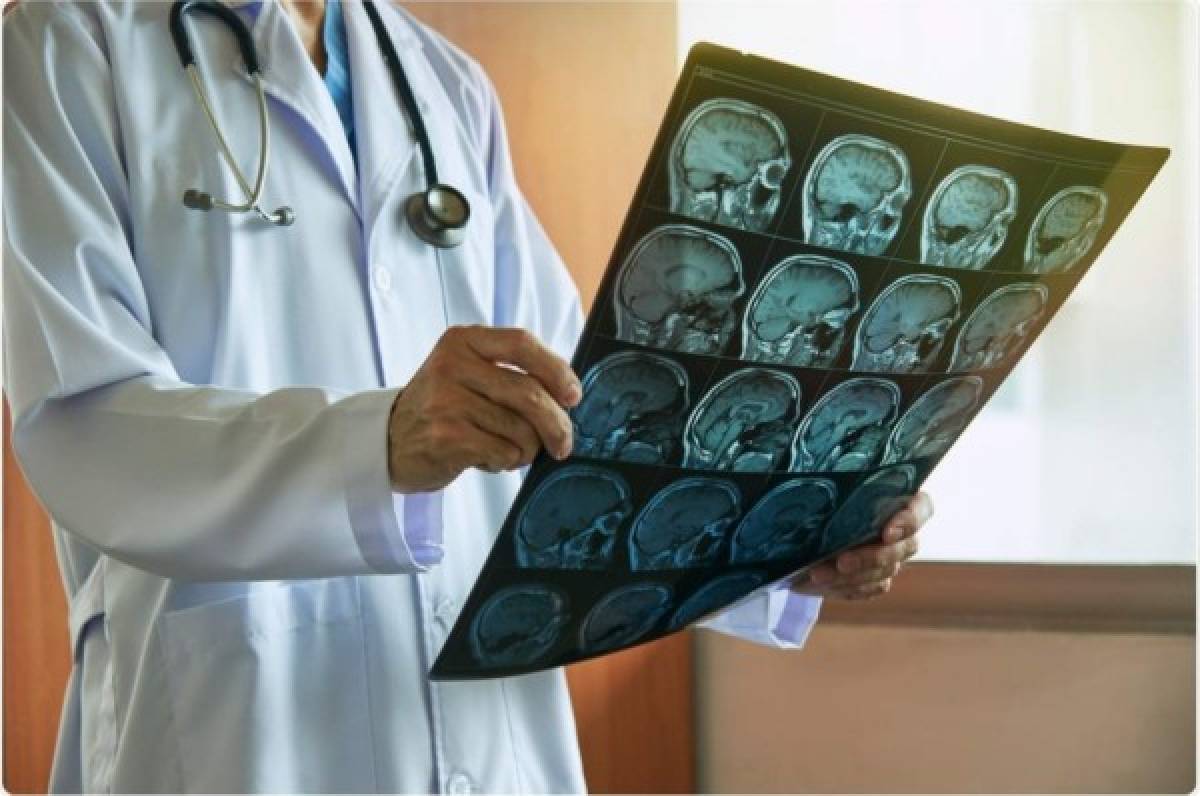 Alerta sobre el nuevo estudio del COVID-19: Puede invadir el cerebro y causar mucho daño
