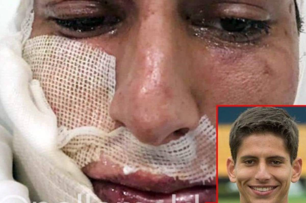 Así de deformado quedó el rostro de futbolista mexicano quemado con pólvora