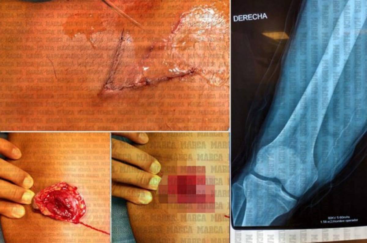 FOTOS: Reconstruyen el muslo de Gio Dos Santos tras lesión en el América-Chivas