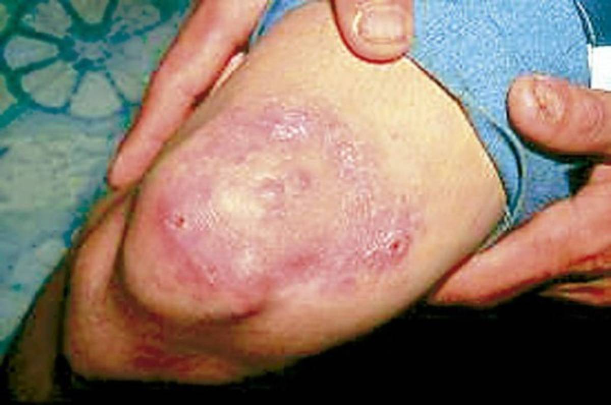 Alerta en México tras reportarse 89 casos de lepra, algo que pone en vigilancia al sector salud