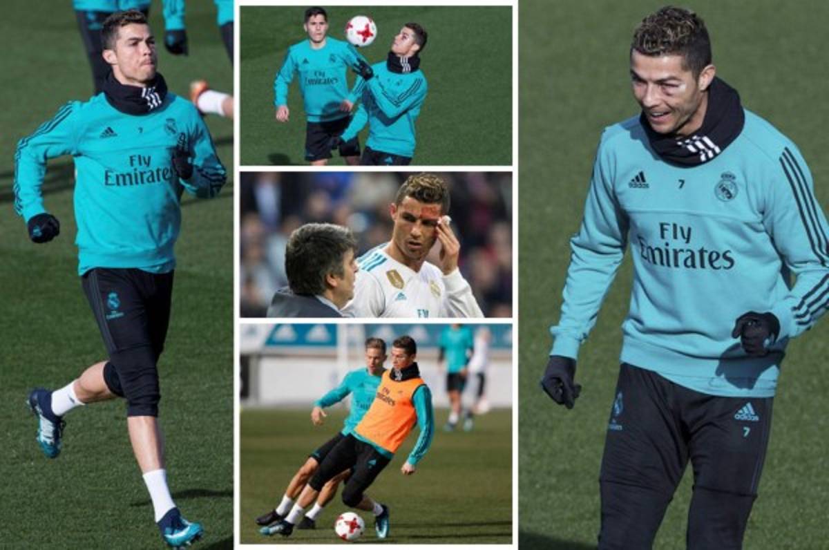 Así luce el rostro de Cristiano Ronaldo dos días después del golpe sufrido ante el Deportivo