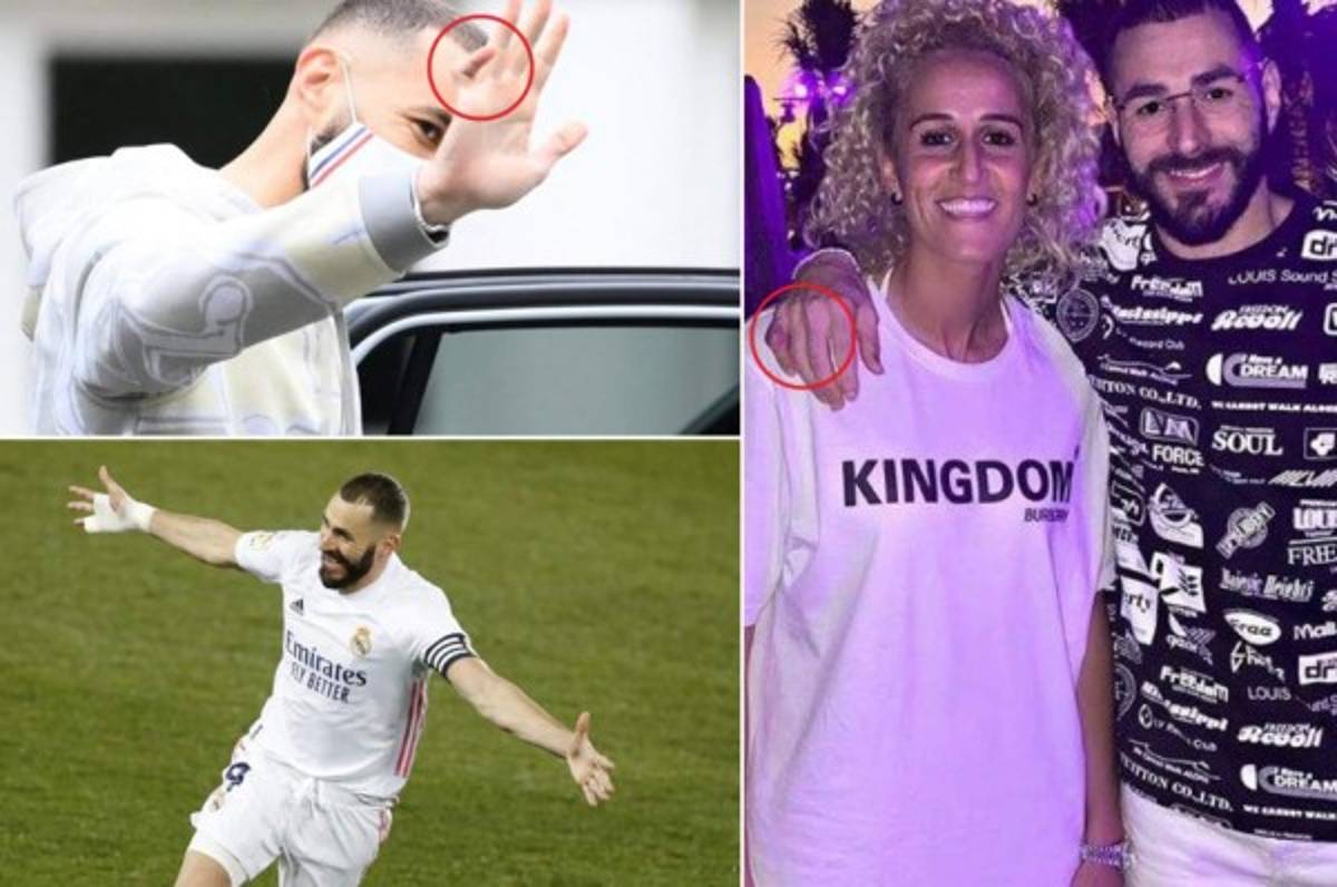El misterio de la mano de Benzema: la razón por la que lleva más de dos años jugando con un vendaje