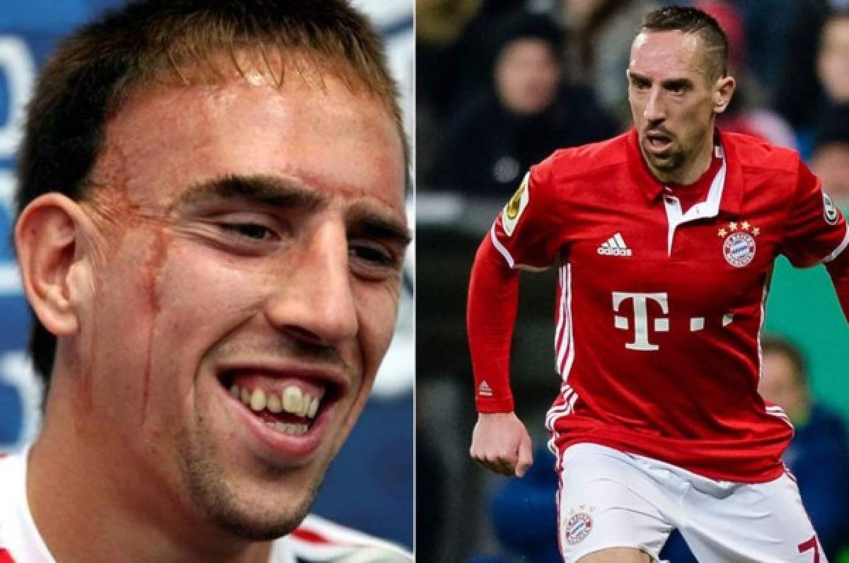 La dramática historia de Ribery y su cicatriz en el rostro