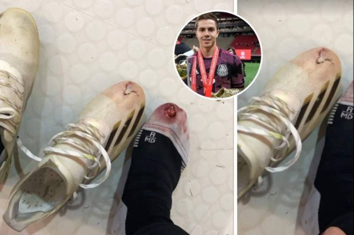 Futbolista mexicano muestra la herida en su pie tras el partido contra Honduras: 'Gajes del oficio'