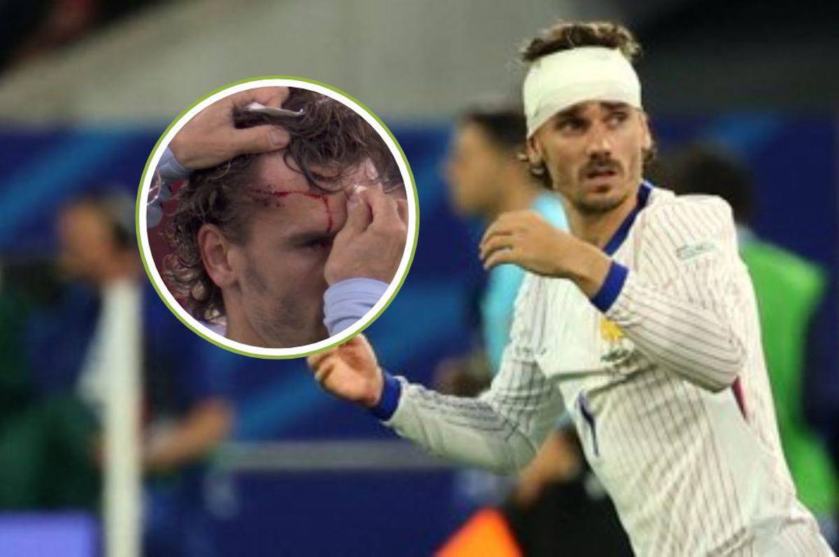 Mbappé se rompe, dardo de MisterChip a Kylian y Griezmann terminó lleno de sangre en el debut de Francia en la Eurocopa