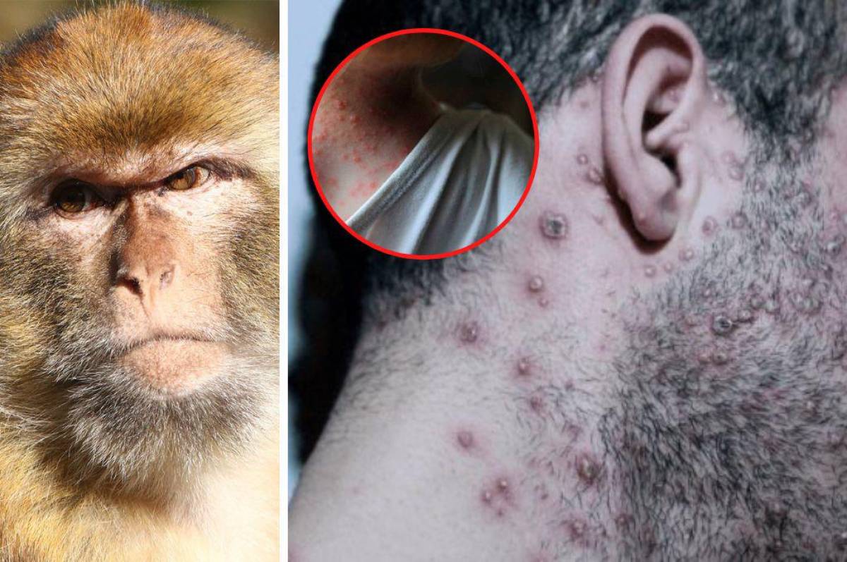 Confirmado: Honduras ya reporta el primer caso de viruela de mono; “Sus contactos están también aislados”