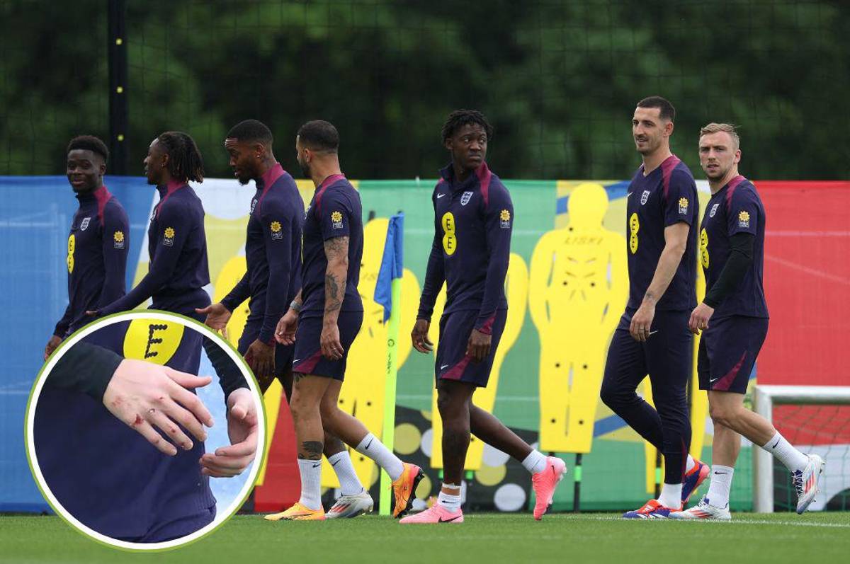 Jugador de Inglaterra sufre accidente previo a jugar los octavos de final en la Eurocopa: “Tenía la cara ensangrentada”