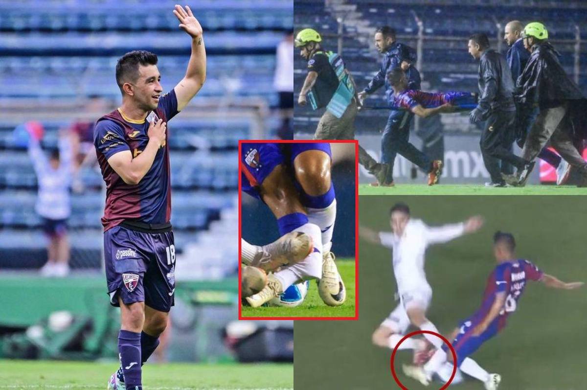 Escalofriante lesión del mexicano Hobbit Bermúdez: así quedó la pierna del jugador y la bronca con el culpable