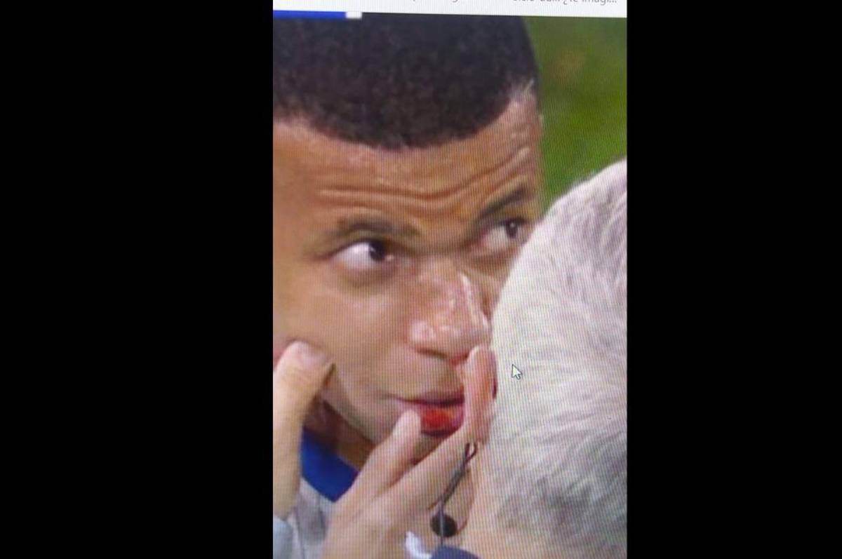 Fotos: Así le quedó la nariz a Mbappé tras rompérsela y lo que informan desde Francia sobre su lesión: “Es lo malo de esta noche”