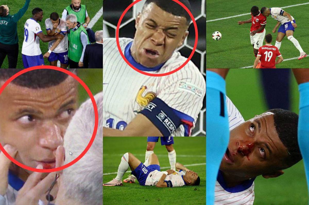 Fotos: Así le quedó la nariz a Mbappé tras rompérsela y lo que informan desde Francia sobre su lesión: “Es lo malo de esta noche”