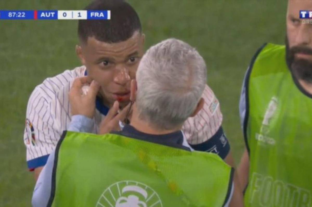 Fotos: Así le quedó la nariz a Mbappé tras rompérsela y lo que informan desde Francia sobre su lesión: “Es lo malo de esta noche”