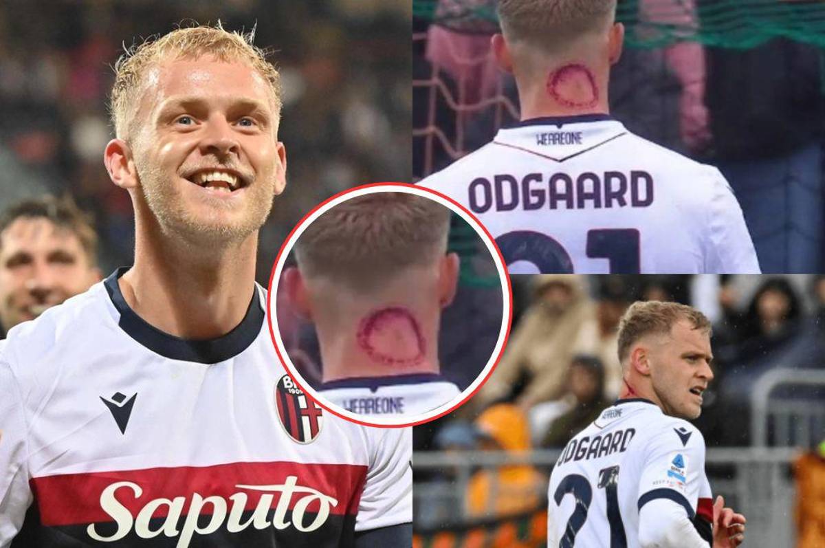 ¿Qué es lo que tiene? la llamativa marca que mostró un futbolista en su cuello y explica todo: Es una mordida zombie”