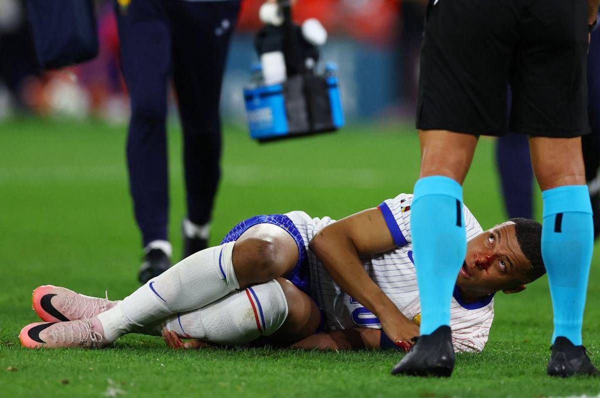 Fotos: Así le quedó la nariz a Mbappé tras rompérsela y lo que informan desde Francia sobre su lesión: “Es lo malo de esta noche”