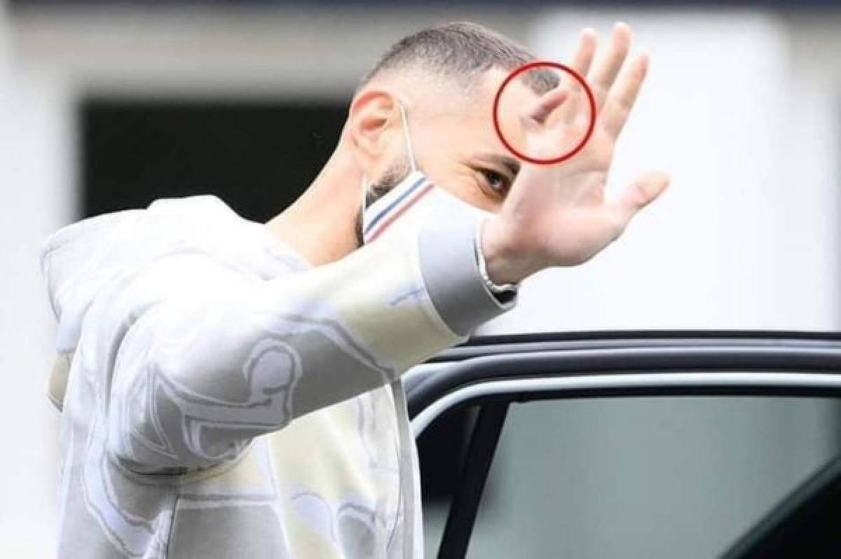 Benzema y la misteriosa lesión en su mano: Así tiene el dedo y aclara por qué no se opera