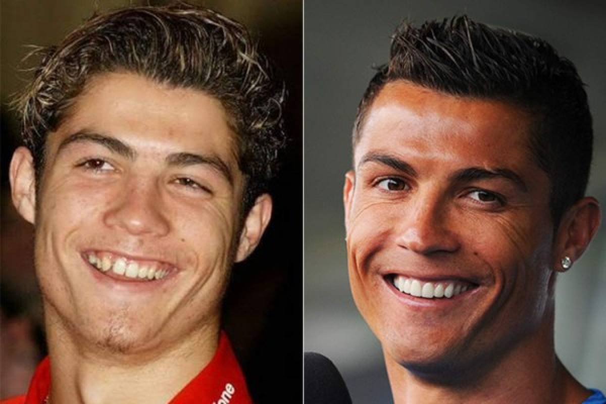 Futbolistas que se han hecho cirugía estética para verse mejor