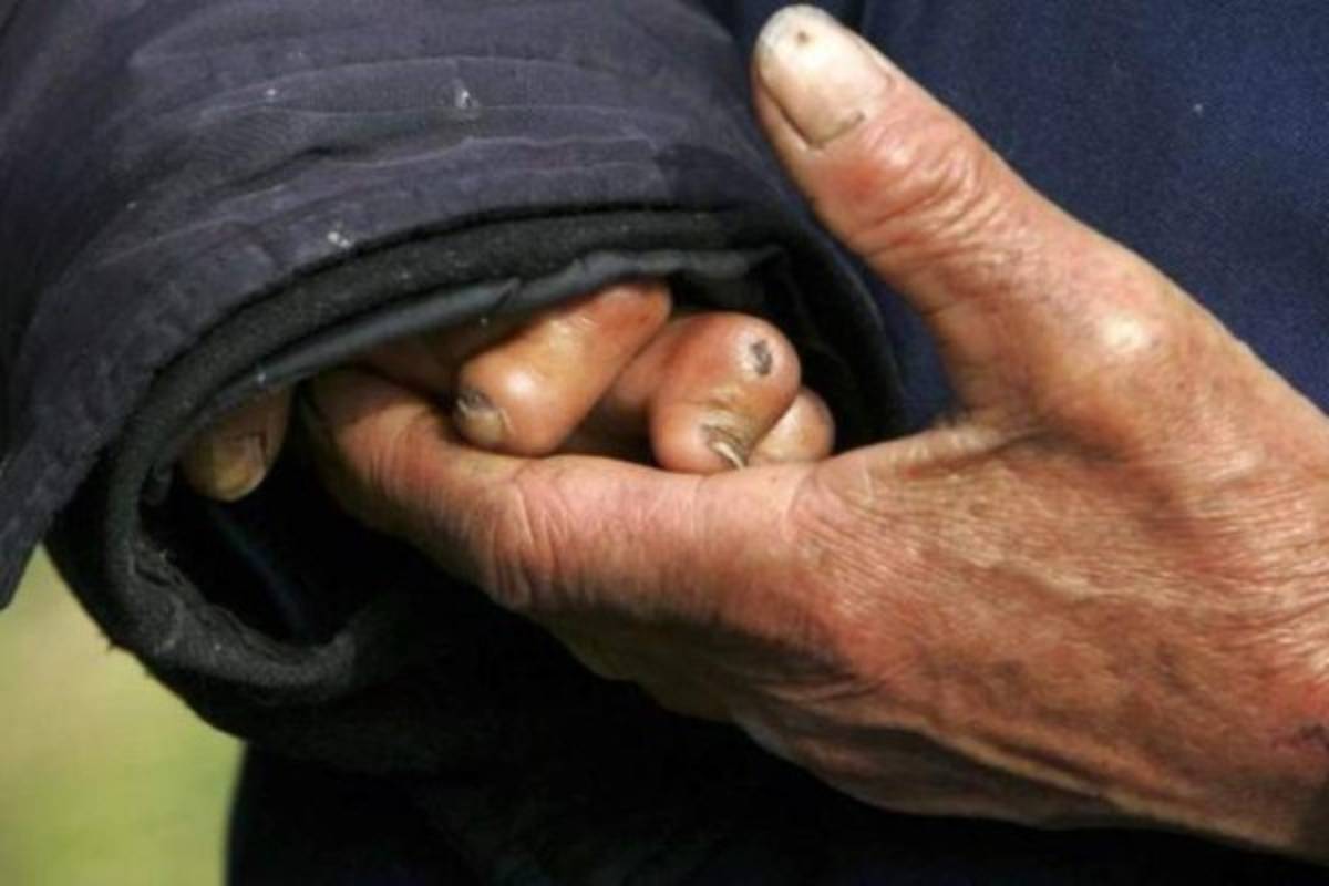 Alerta en México tras reportarse 89 casos de lepra, algo que pone en vigilancia al sector salud