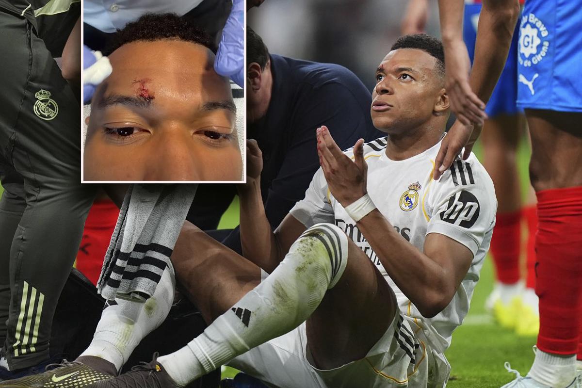 Mbappé muestra como quedó su rostro tras sufrir una agresión: Los tres puntos de la vergüenza
