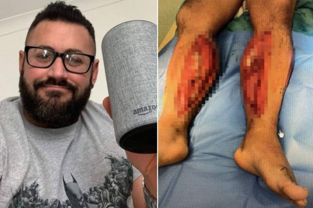 Un culturista se aplasta las piernas, le explotan las venas y Alexa de Amazon le salva la vida