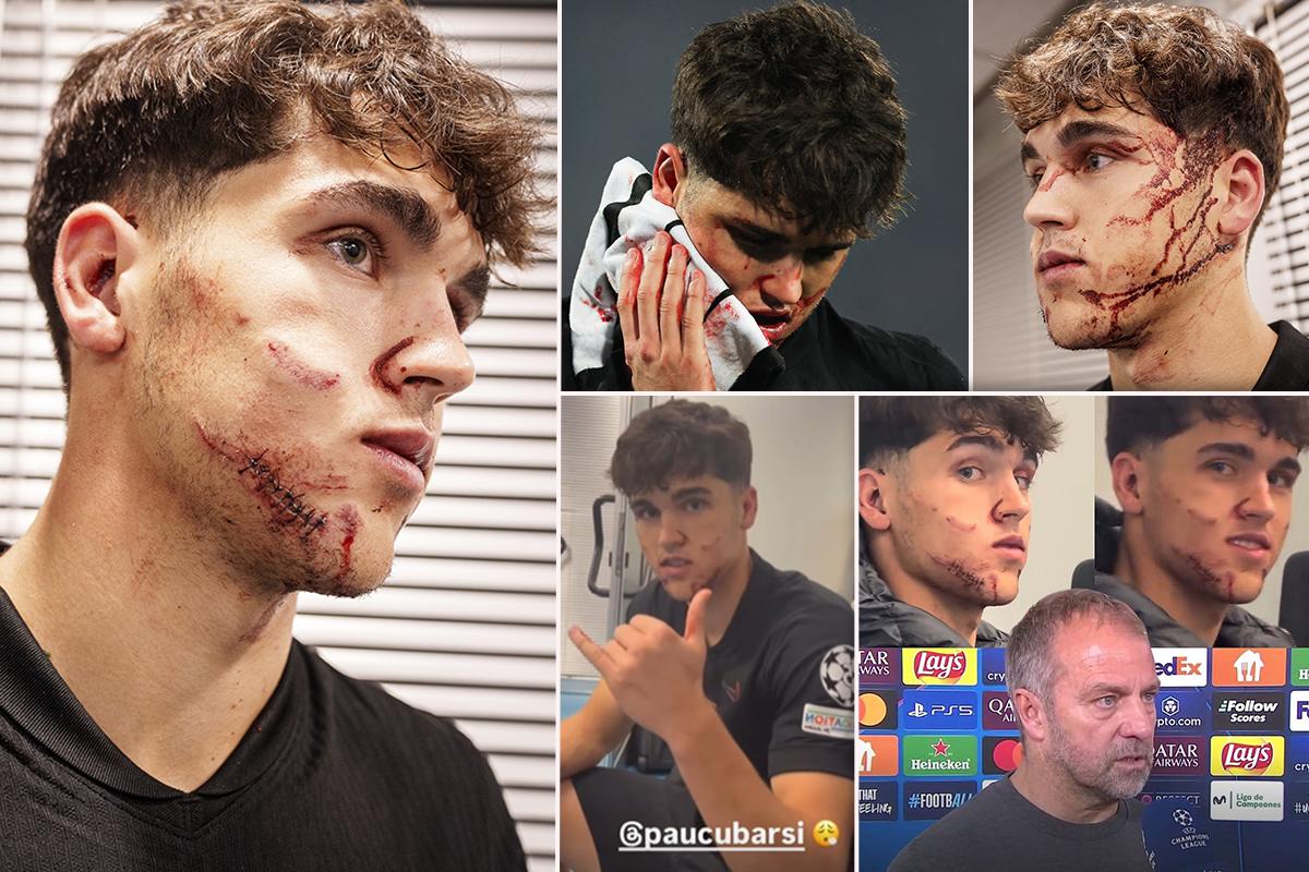 “Me salpicó su sangre, el corte es impactante”: así quedó la cara de Cubarsí tras sufrir una patada en la Champions