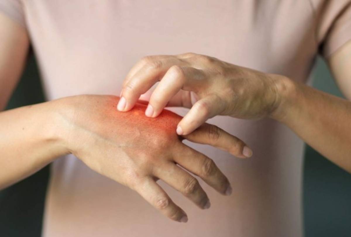 Alerta en México tras reportarse 89 casos de lepra, algo que pone en vigilancia al sector salud