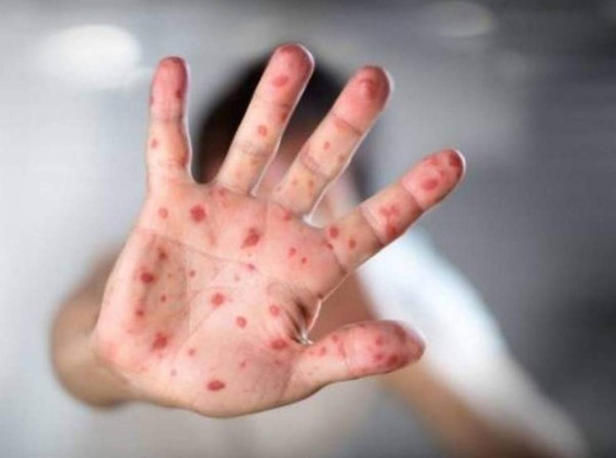 Las pandemias más mortíferas que han azotado a la humanidad a lo largo de la historia