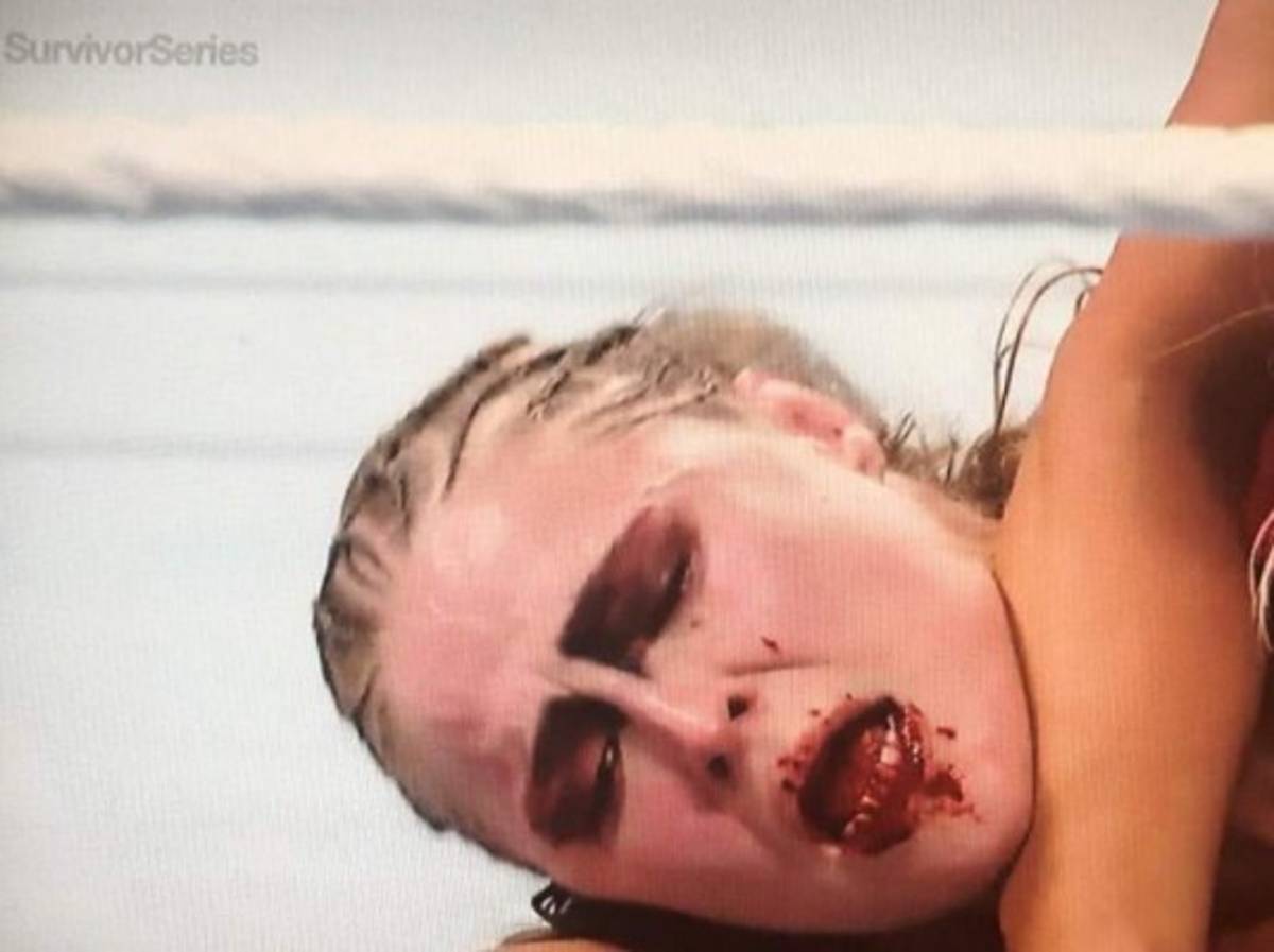 Moretones y heridas: Las fotos actualizadas de cómo quedó Ronda Rousey una semana depués de la paliza