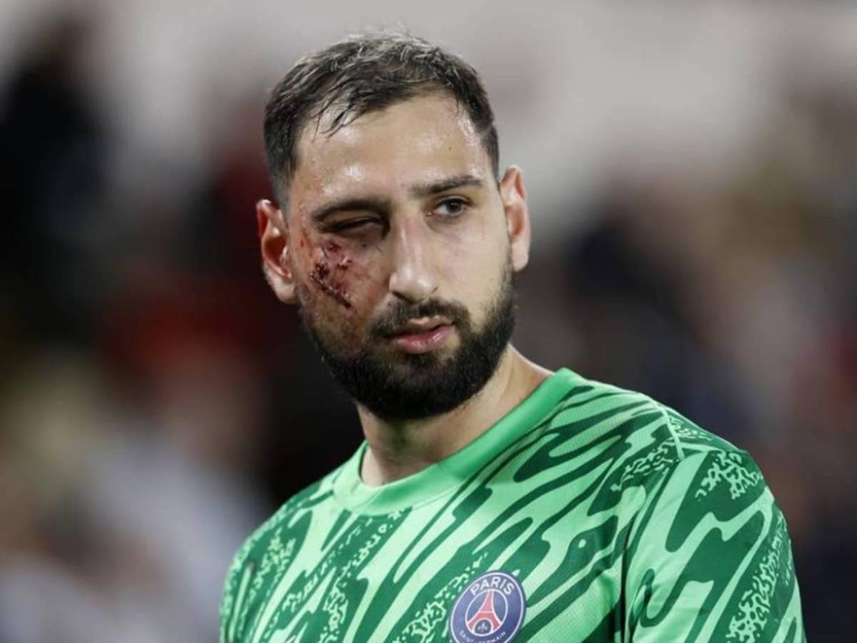 La impactante lesión de Donnaruma que recibió una patada en el rostro y tuvo que ser reemplazado ante Mónaco