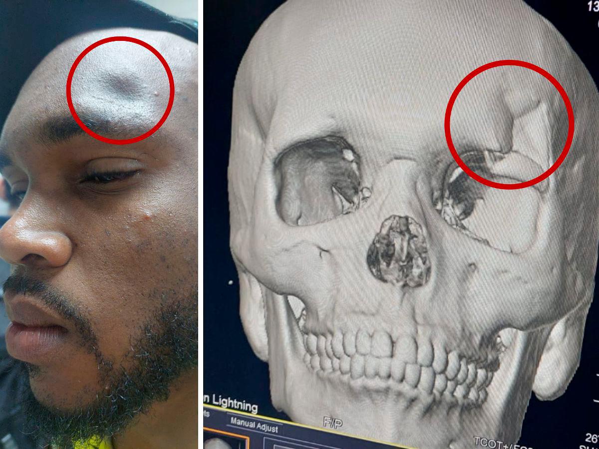 Un hoyo en la cabeza: Futbolista del Génesis fue llevado de urgencias al hospital tras brutal encontronazo con Yustin Arboleda